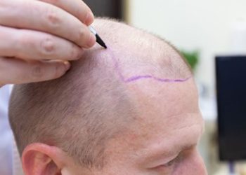 “Saç ekimi hastane ortamında yapılmalı” (İstanbul’da her gün 5 bin saç ekimi yapılıyor)